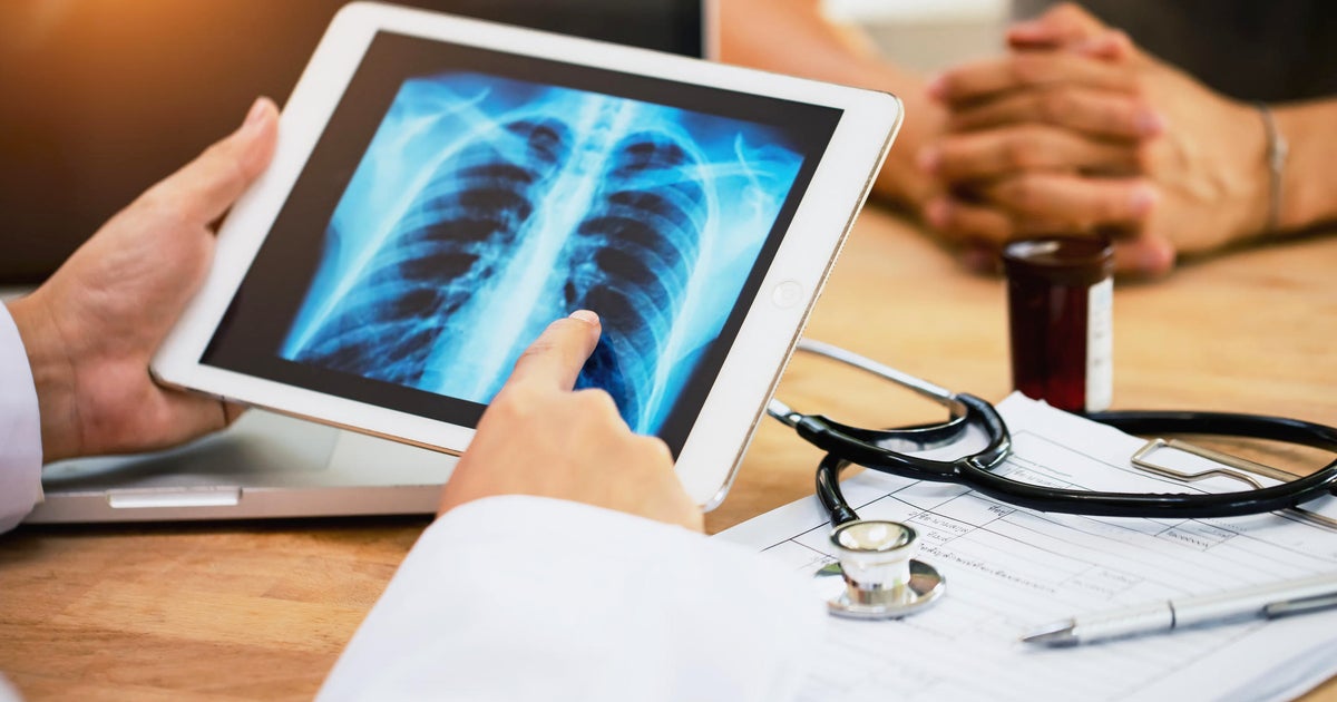 Lung cancer screenings save lives but are unfamiliar to most. Doctor explains what to know. Lung cancer screenings save lives but are unfamiliar to most. Doctor explains what to know.