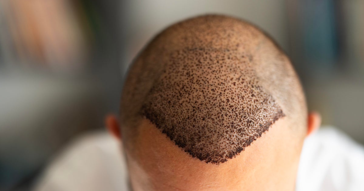 Thinking of a hair transplant? Here’s where many Americans are heading. Thinking of a hair transplant? Here’s where many Americans are heading.