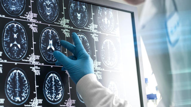 Doctor analyzing patients brain scan on screen