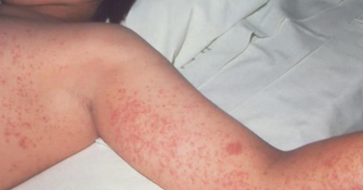 Minnesota facing growing number of measles cases