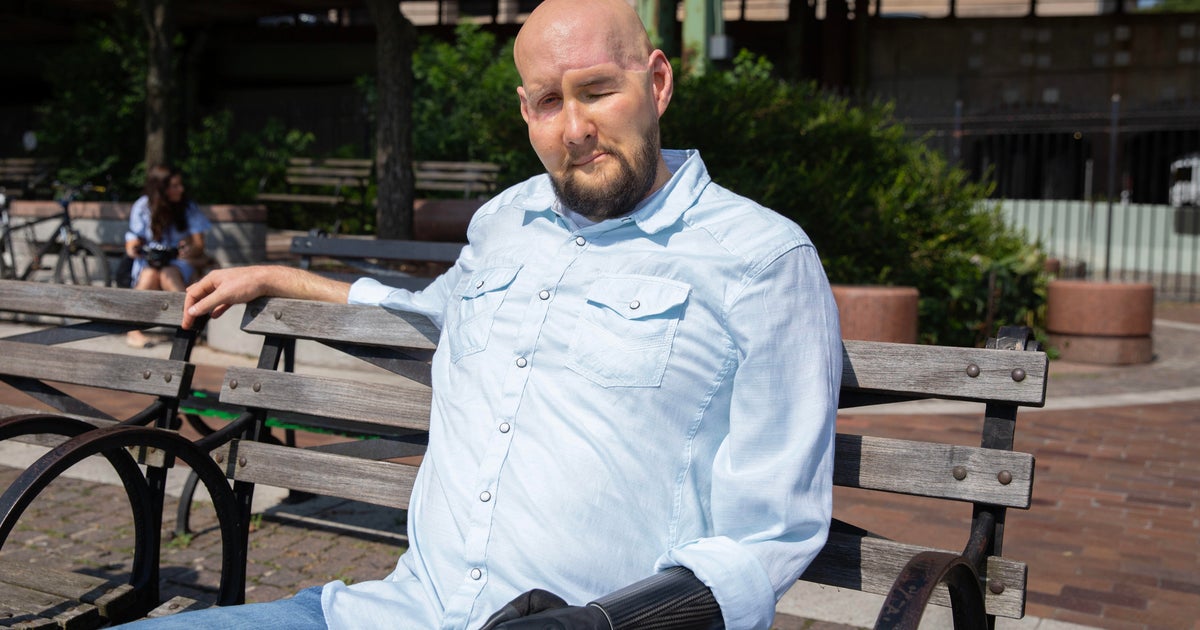 Eye transplant recovery leaves doctors "truly amazed"