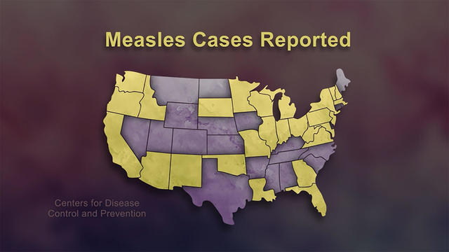 measles-cases-reported-1920.jpg 