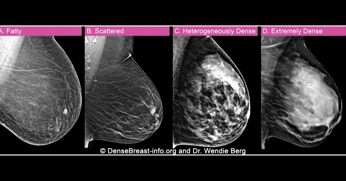 Her breast density camouflaged her cancer. She says the new FDA rules are “a gift.”