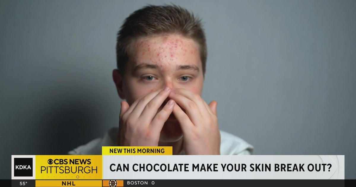 Can chocolate cause breakouts? - CBS Pittsburgh