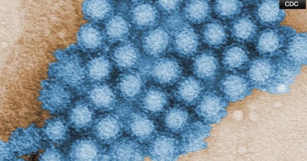 How to avoid catching the norovirus - CBS Pittsburgh