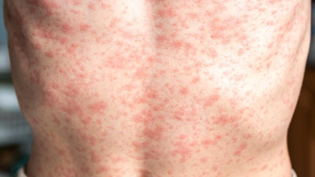 cbsn-fusion-child-dies-after-contracting-measles-in-texas-officials-say-thumbnail.jpg