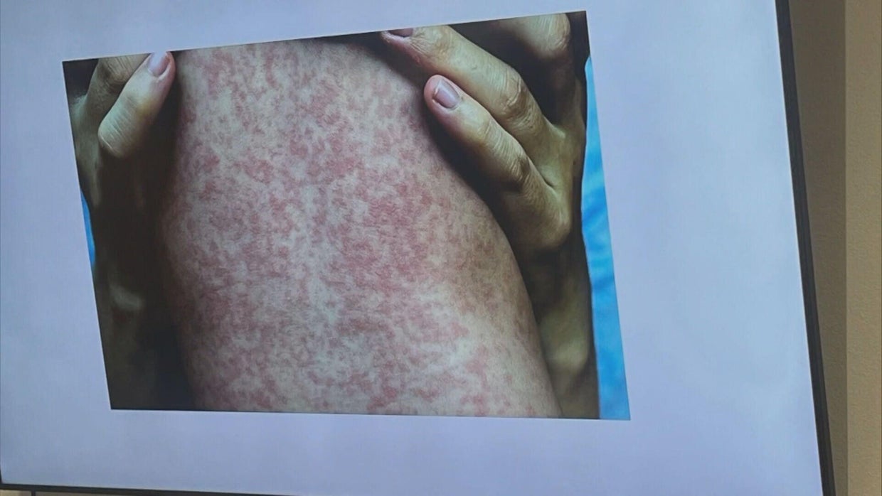 measles-vaccine-5pkg-frame-1351.jpg 