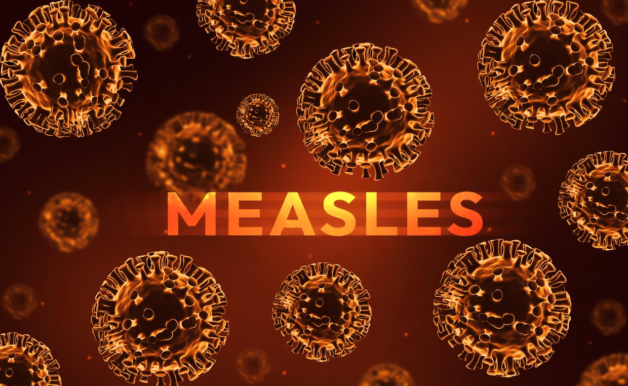Measles cases in two Dallas-Fort Worth counties linked to West Texas ...