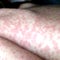 Doctors face new challenge as U.S. measles cases hit 33-year high