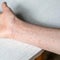 U.S. measles numbers reach highest levels in 33 years