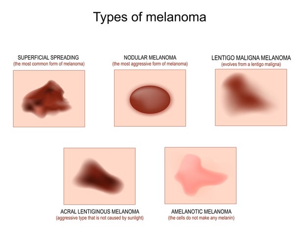 Types of  melanoma 