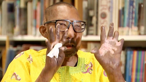 18pkg-ss-first-black-male-face-transplant-frame-1646.jpg 