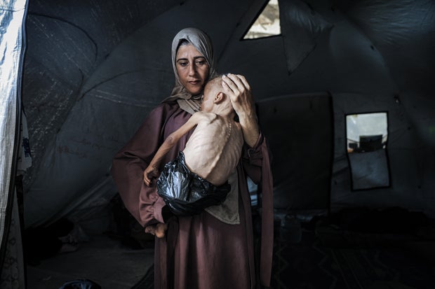 Malnourished toddler in Gaza fights for life amid ongoing Israeli attacks 
