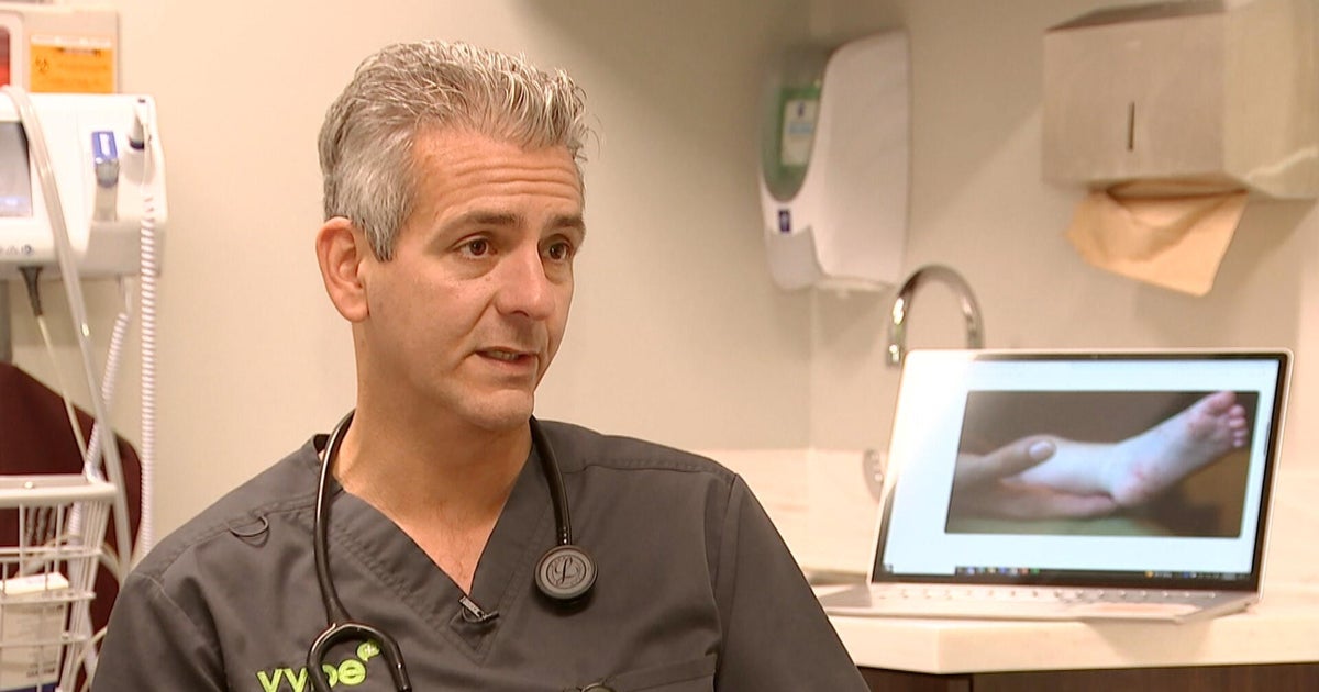 Cases of hand, foot and mouth disease are growing throughout the Philadelphia region 