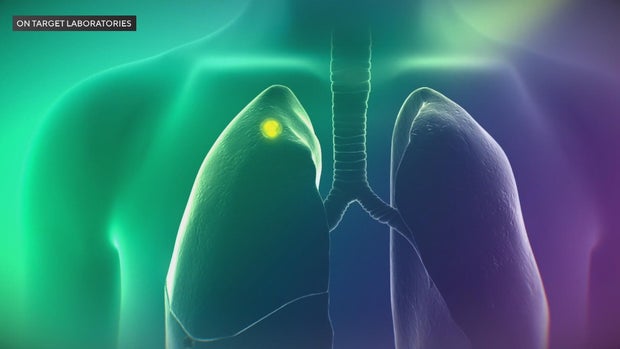 A small section of a lung is highlighted in this illustration 