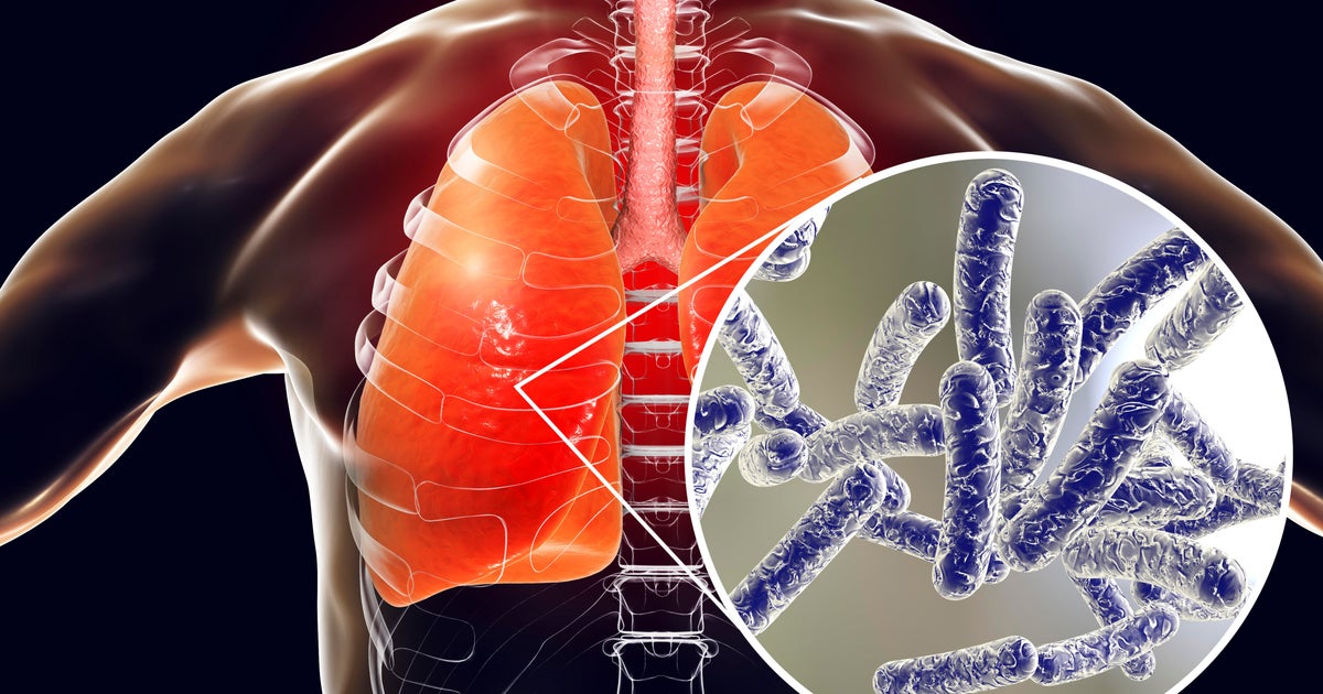 Legionnaires' disease cluster in Harlem now responsible for 90 cases 