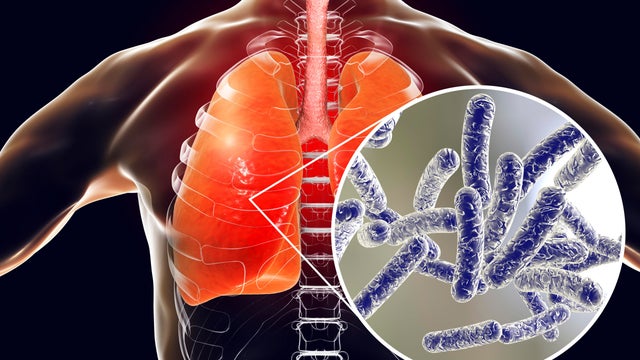 Legionnaires disease, conceptual illustration 