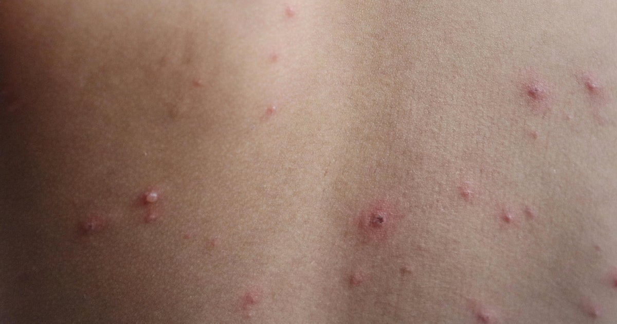 Wisconsin officials report potential measles exposure at 2 travel stops