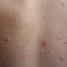 Second case of measles for 2025 confirmed in suburban Cook County 