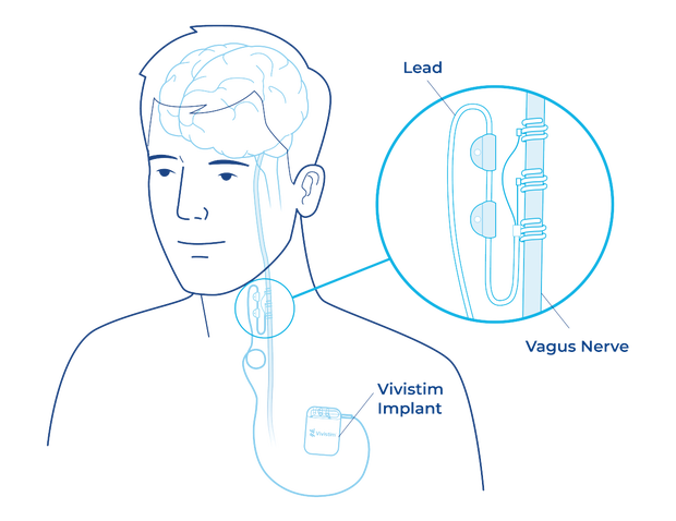vivistim-paired-vns-system-implant-diagram-callout-labels.png
