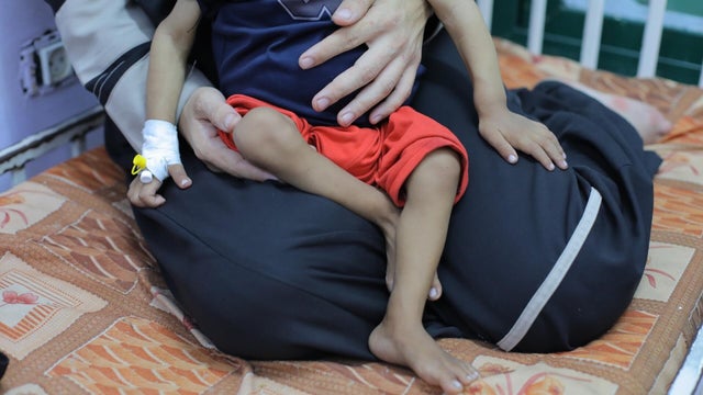 Children suffering from malnutrition in Gaza receive treatment under limited conditions. 