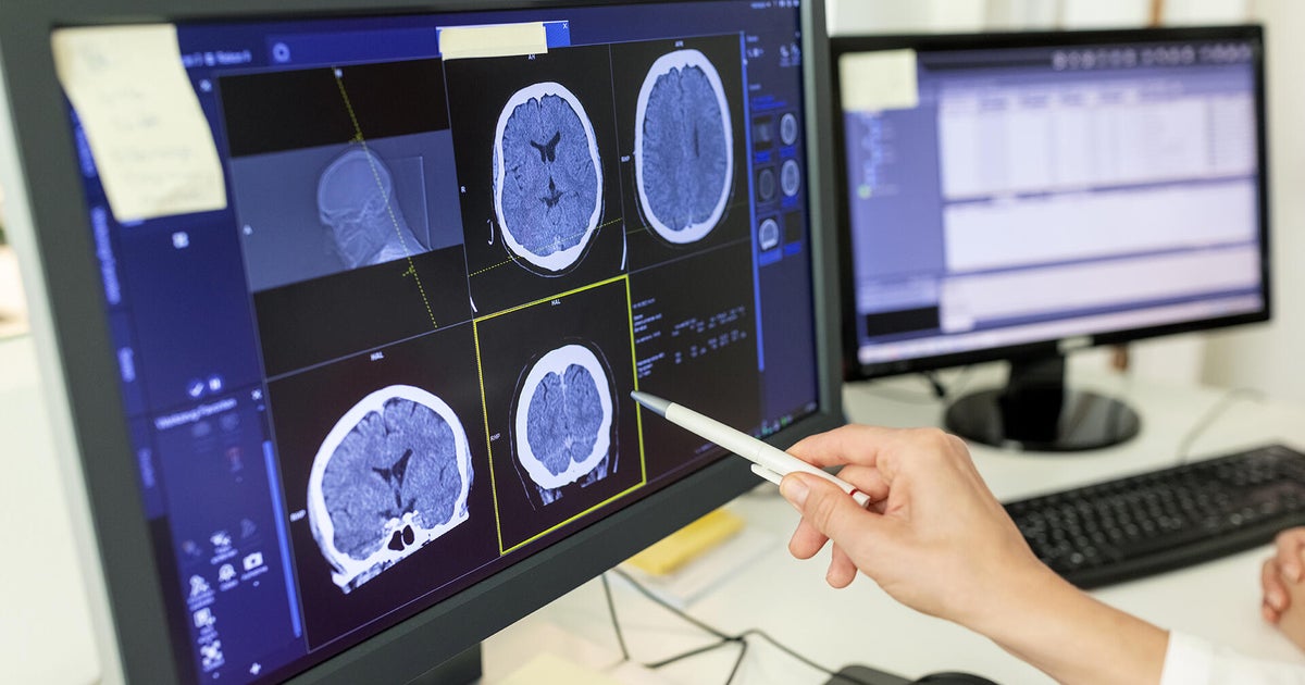 New research finds hyperlink between traumatic mind accidents and mind most cancers danger