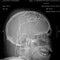Dr. Sanjay Gupta on the mysteries of chronic pain