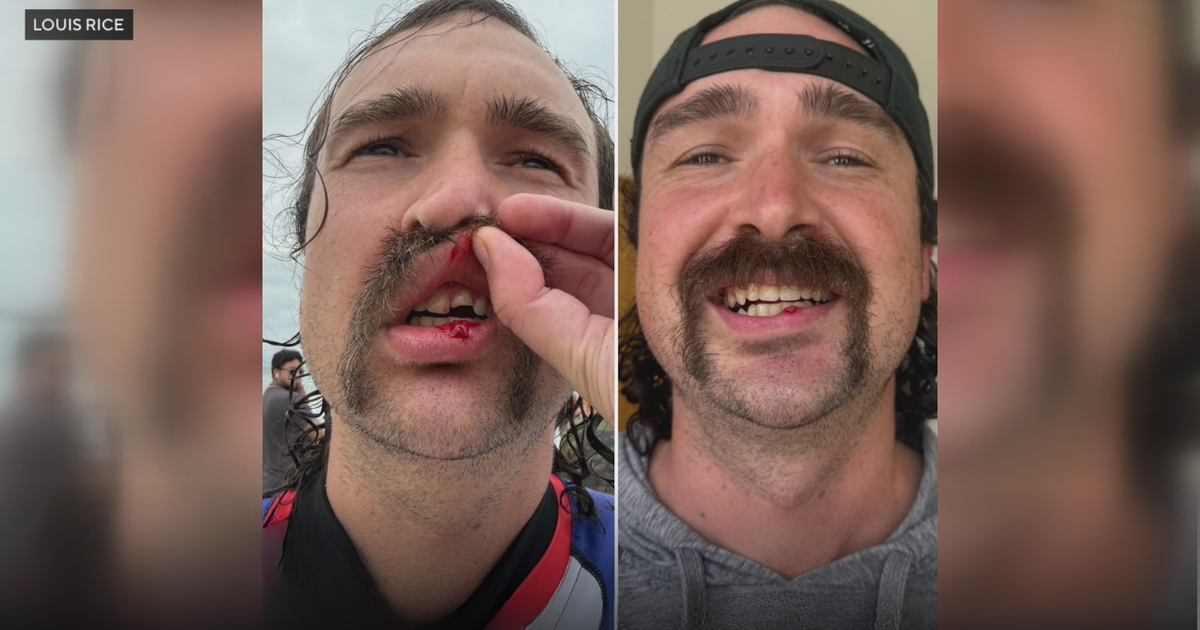 How Did a Huntington Beach Dentist Assist a Surfing Marine Veteran with a Broken Tooth?