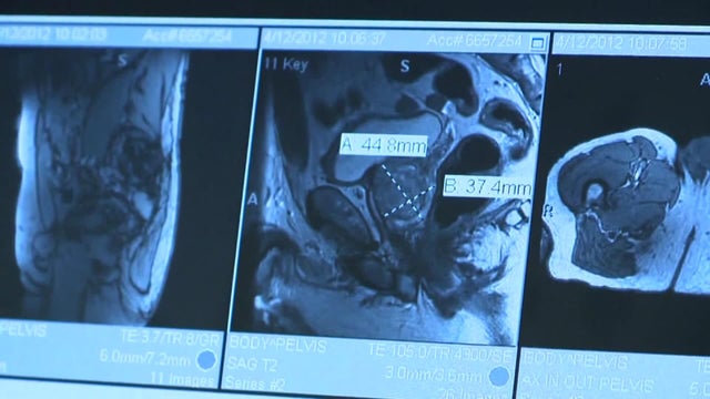 119-b-tz-vo-prostate-ca-wforc7wo.jpg 
