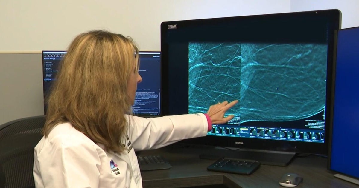 How mammograms can spot hidden signs of heart disease