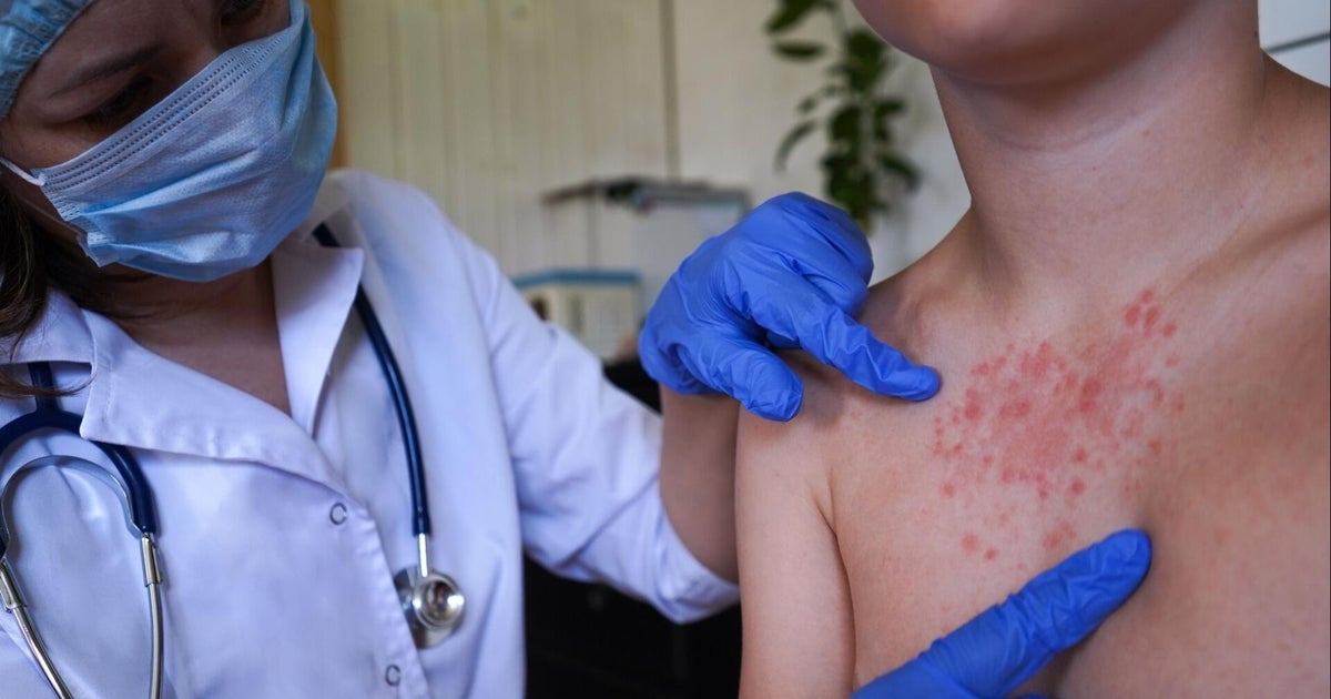 US Reports Highest Measles Surge in Three Decades With 1,618 Cases, 3 Deaths