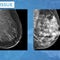 Doctors using AI mammogram readings to predict breast cancer risk