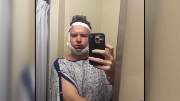 Victim speaks out after unprovoked attack in Philadelphia leaves him badly injured 