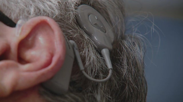 for-web-cochlear-implant.jpg 