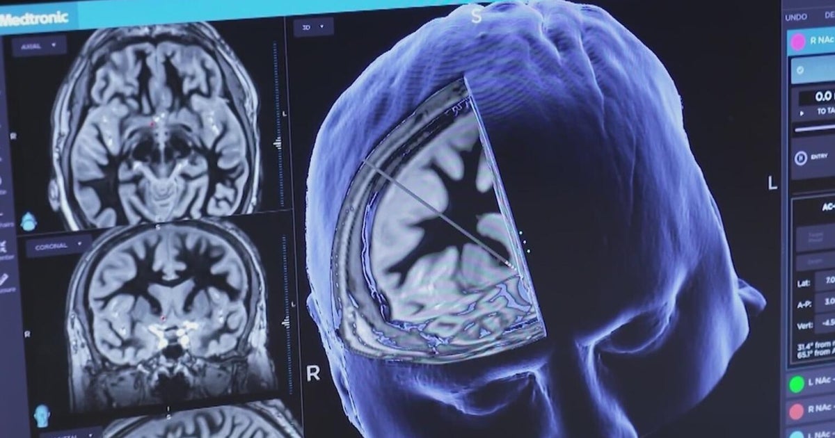 Non-profit, search and rescue experts write wandering toolkit for those with dementia