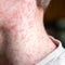 South Carolina confirms 138 cases of measles amid outbreak