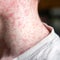 Measles becoming "entrenched" in U.S. again, doctor says, as non-travel-related cases grow
