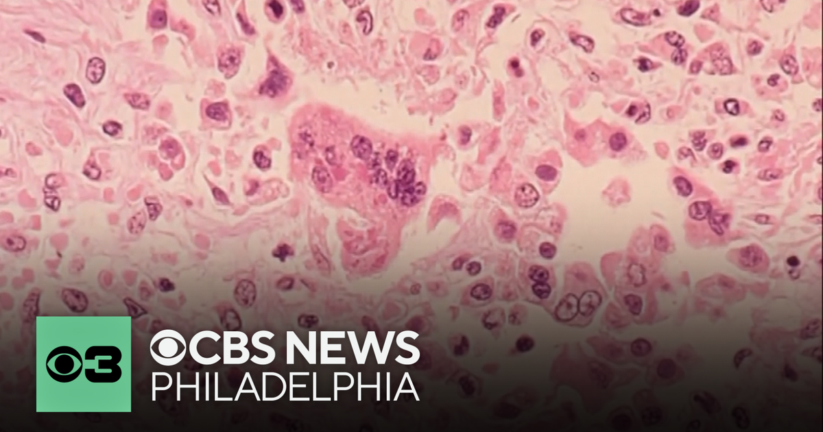 Health officials warn of possible measles exposure at Newark Liberty International Airport