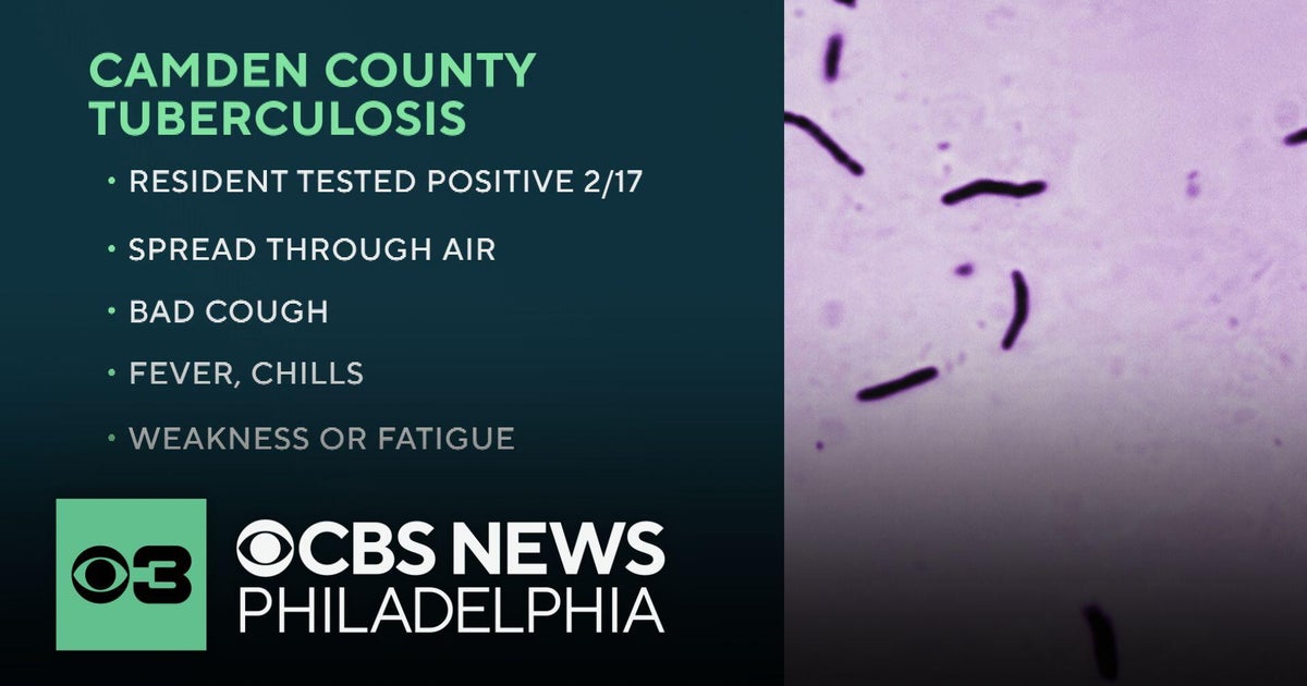 New Jersey resident tests positive for tuberculosis, health officials say
