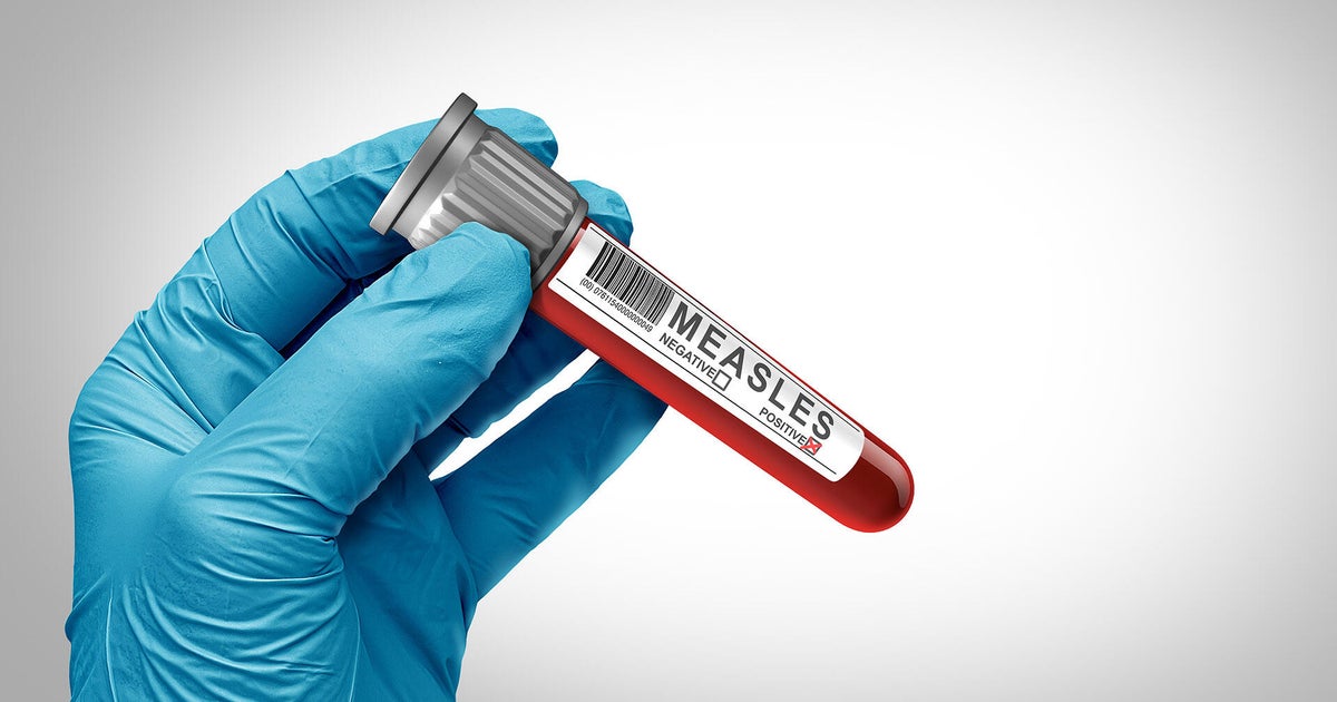 Florida measles cases jump almost 25% in a week, making it the state with the 3rd most in the country