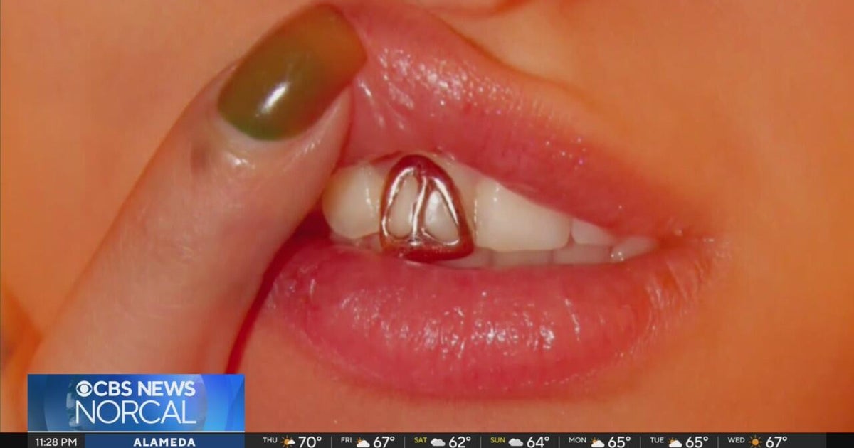 San Francisco artist turns teeth into canvas with custom grills