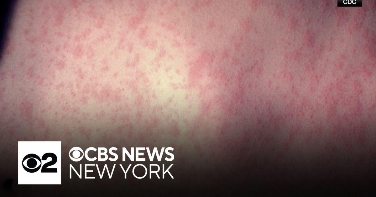 NYC health officials warn of possible measles exposure at restaurant