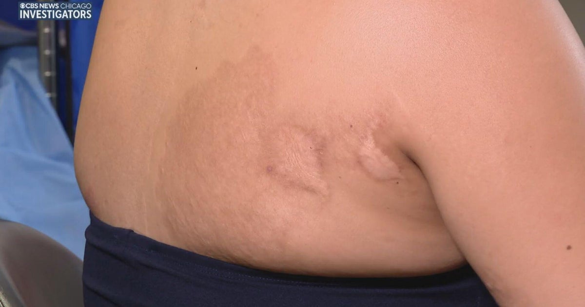 With Fourth of July comes surge in fireworks injuries; doctor urge ...