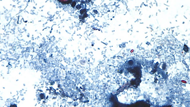 Cyclospora Outbreak 