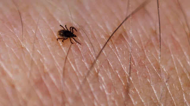 A small tick on a person's skin 