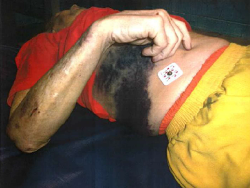huerfano-jail-death-lawsuit-torso-injury-from-rathod-mohamedbhai-law-firm-representing-family-of-michael-john-birch.png 