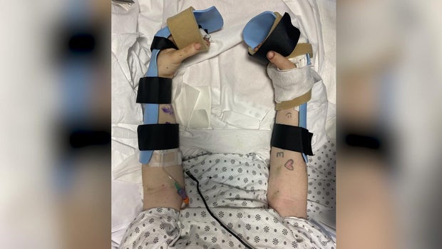 Kaitlynn Berman in hospital bed with injuries to her arms and hands
