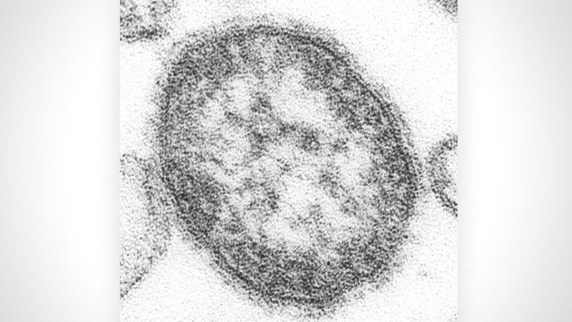 cbsn-fusion-what-to-know-about-the-measles-related-deaths-in-pennsylvania-thumbnail.jpg 