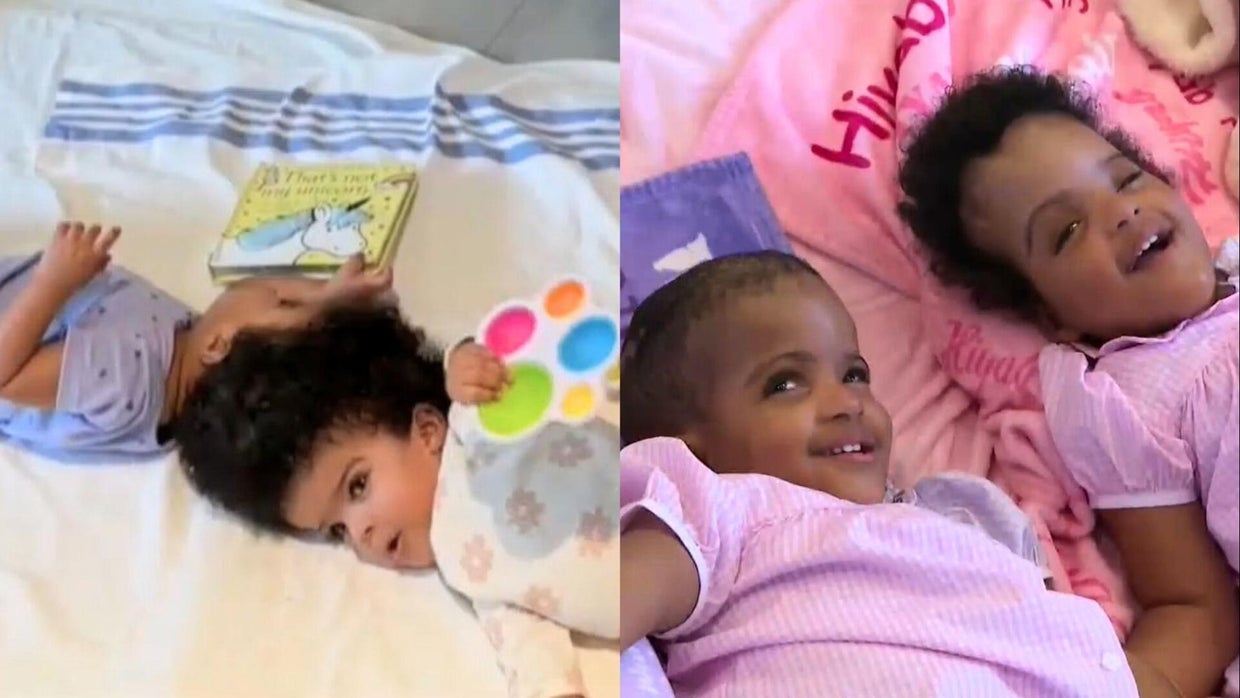 cbsn-fusion-doctors-successfully-separate-twin-girls-conjoined-head-thumbnail.jpg