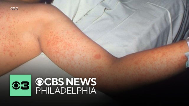 5th measles-associated death of 2026 reported in Pennsylvania, health officials say